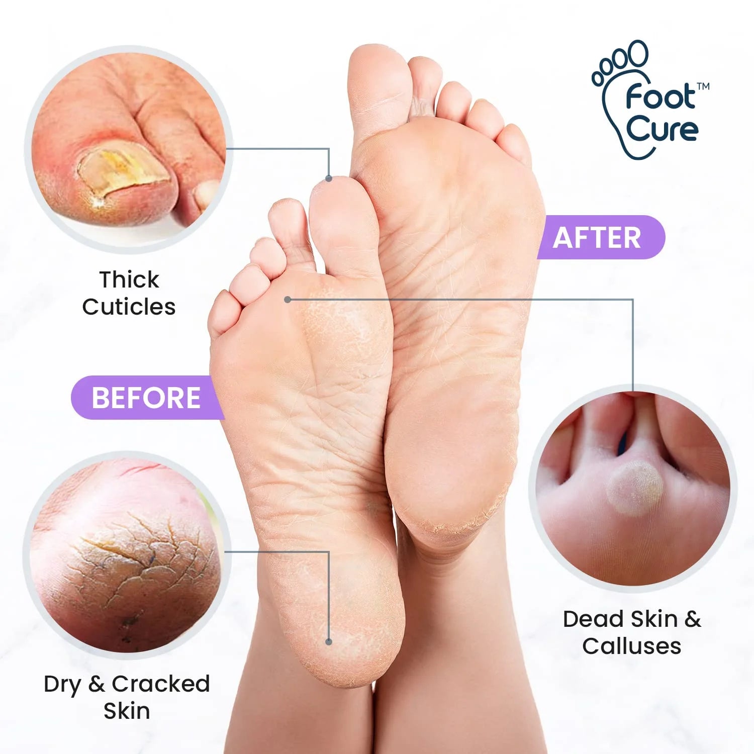 Lavender Foot Soak & Callus Remover Gel Kit - Remove Calluses with Epsom Salts, Callus Remover Gel for Dry Cracked Heels & Foot Odor